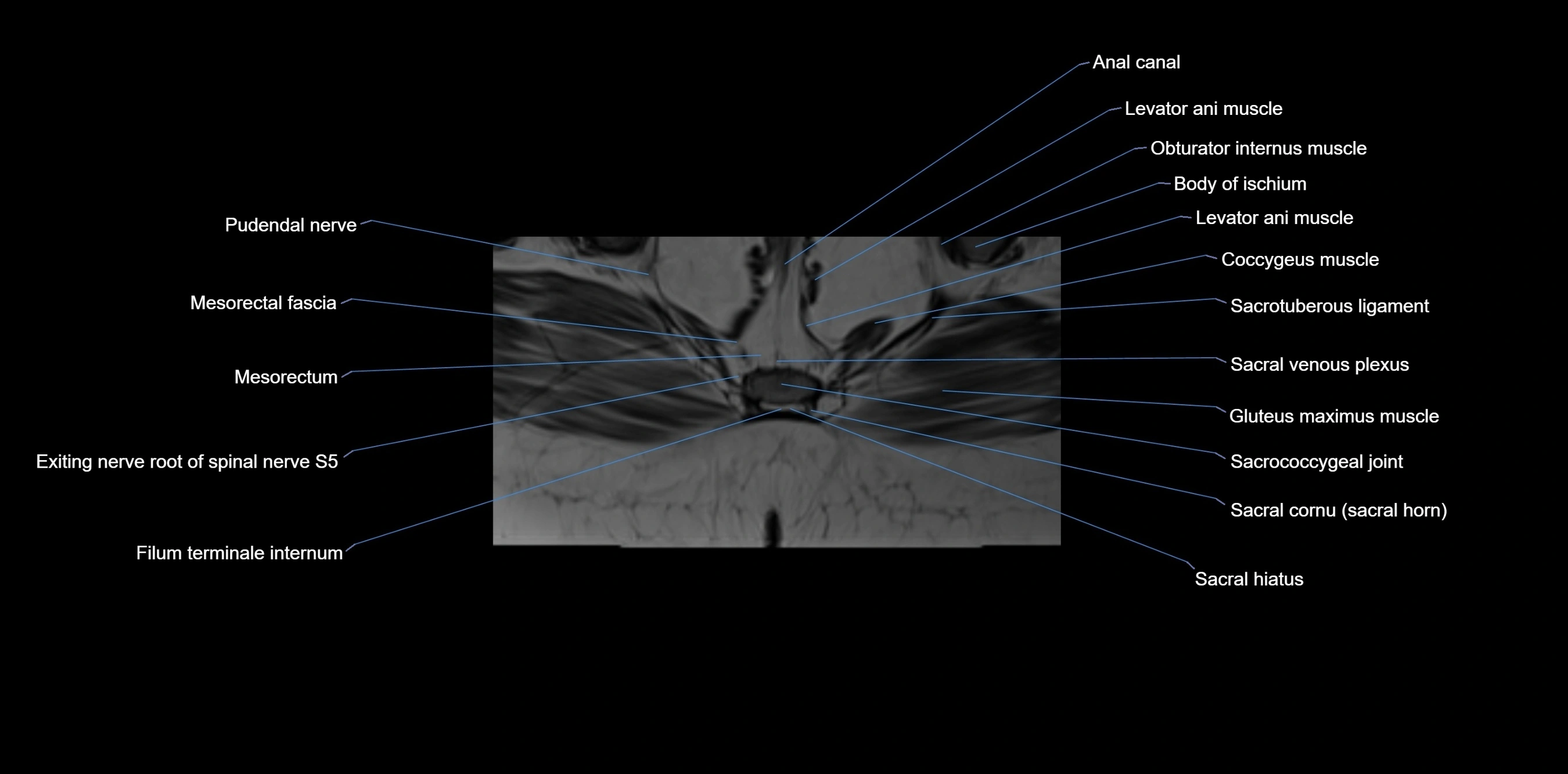 MRI sacrum, coccyx and sacroiliac joint axial cross sectional anatomy 3T  radiology  image-img-00001-00064.webp